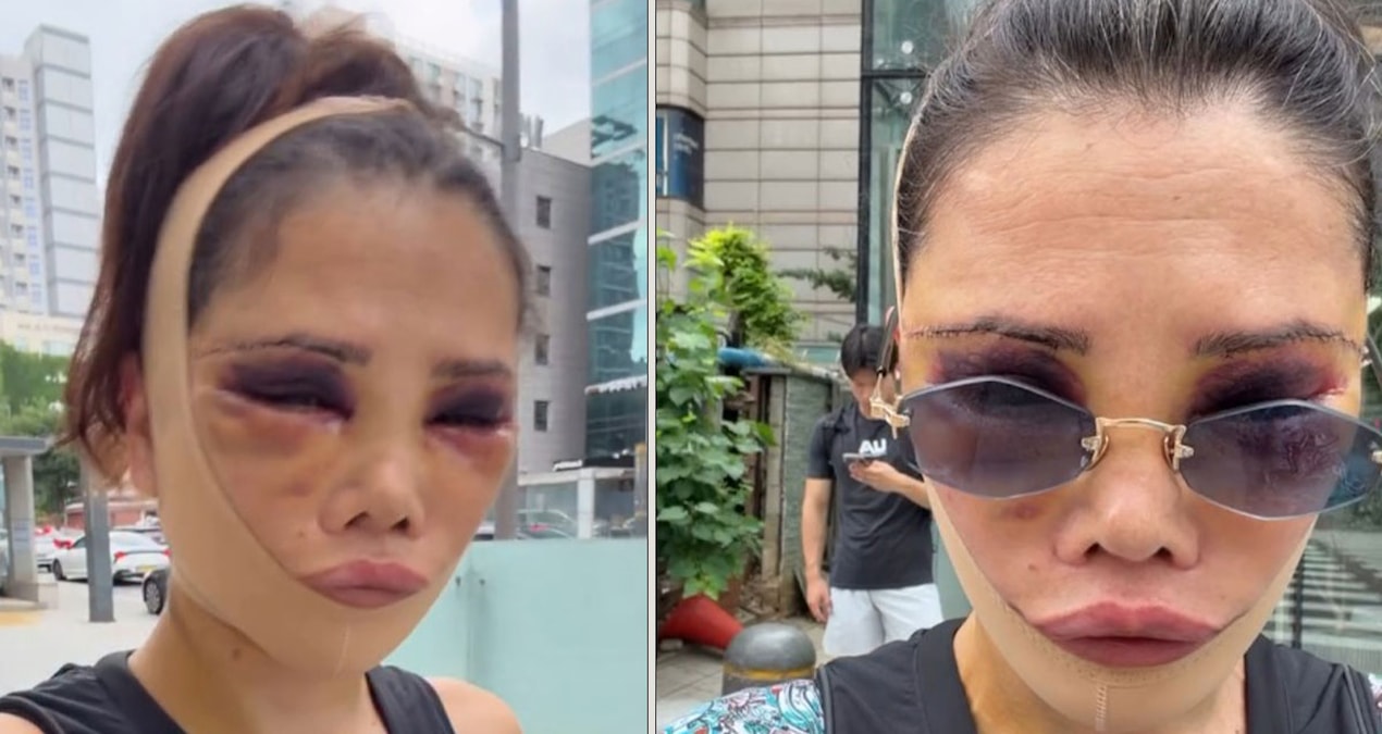 Analysis | Didem Ceran had surgery again: She shared her latest version and responded to criticism: Here are the Details
