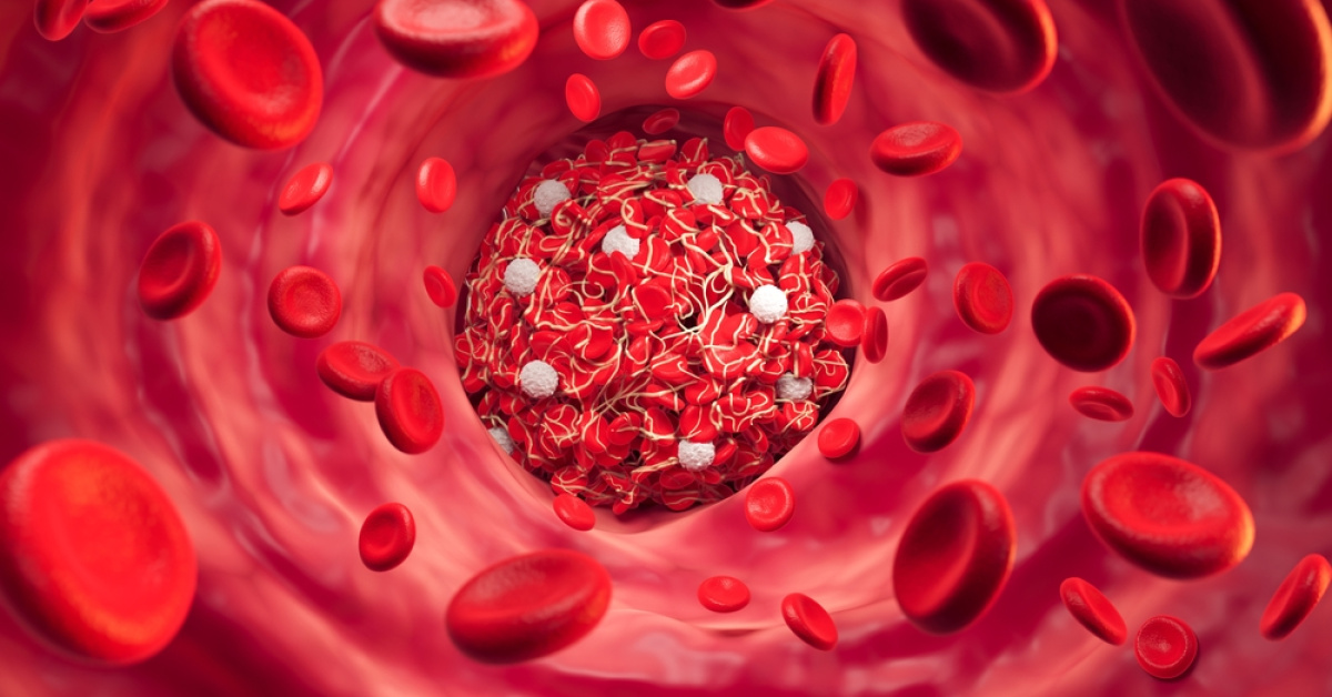 Agenda - Inactivity during holiday trips can increase the risk of hidden clots: Here are the Details