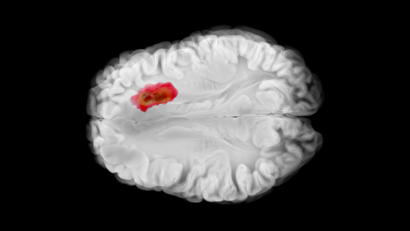 Latest Development: The 'traitor' cell in the brain has been revealed! How was the shield protecting cancer shattered? (Detail)