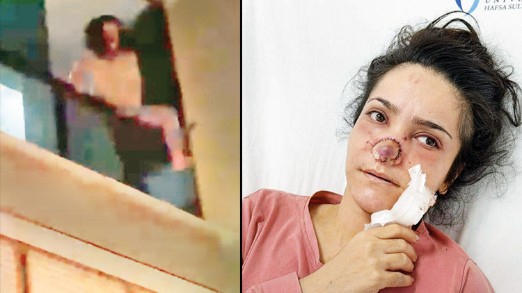 Burnu ısırılıp koparılan İmran: Acıdan atlamayı düşündüm (Detaylar) - Son Dakika Bilgileri