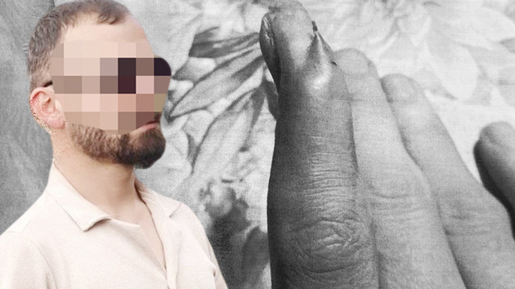 Kritik Açıklama: Son Gelişme: Çıkarılamayan iğne için ihmal davası ve Merak Edilenler