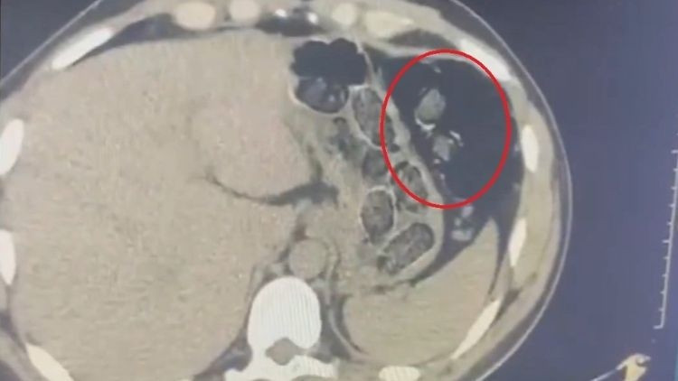 Ayrıntılar Netleşti: Midelerinden uyuşturucuyla yakalanan 2 şüpheli hakkında tutuklama kararı verildi - Son Da