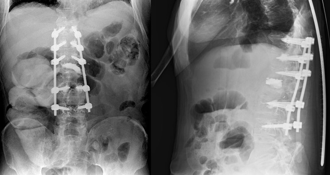 Ayrıntılar Netleşti: Ağrı şikayetiyle hastaneye geldi, 8,5 kilogramlık tümörlü böbrek çıktı - Son Dakika Haber