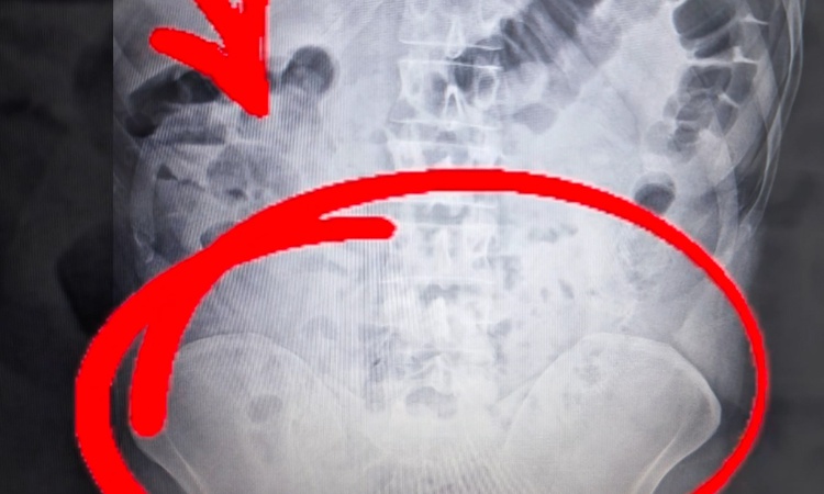 Ayrıntılar Netleşti: Aksaray'da midelerinden 1 kilo 250 gram eroin çıkan 4 kişi hakkında tutuklama kararı veri