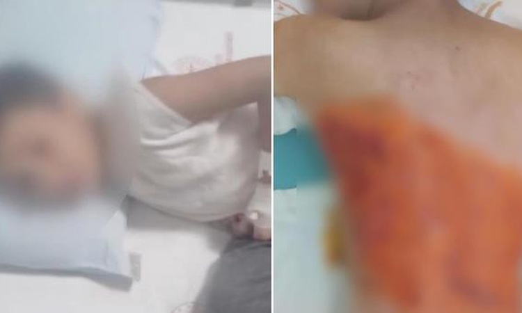 Ayrıntılar Netleşti: ARNAVUTKÖY SON DAKİKA! 12 yaşındaki çocuğun yanması olayı nedir, kim yaptı? | İşte Tüm Ay