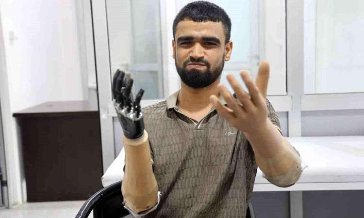 Muhammed, whose life was ruined when the iron touched the electrical wires, received a prosthetic leg worth 3 million TL and 2 bionic arms - Last Minute