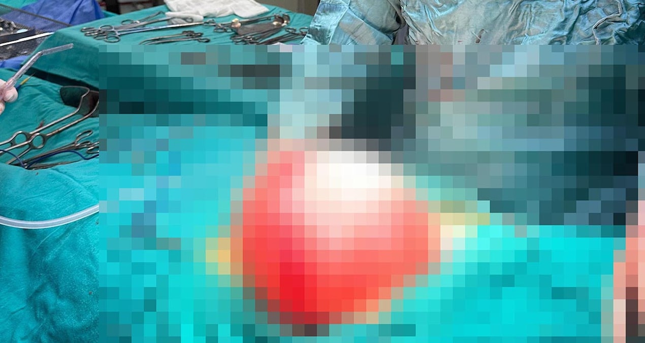 Gündemden Son Bilgiler: Kilolalarından kurtulmak için gitti, karnından 3,5 kilo kist çıktı - Haberleri ve Mera