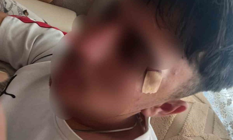 Kritik Açıklama: Afyonkarahisar'da 16 yaşındaki çocuğun burnu öğretmenin kafa atması iddiasıyla kırıldı ve Mer