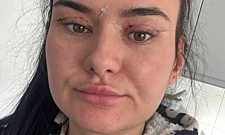 Kritik Açıklama: Yurtdışında ucuz göz kapağı ameliyatı komplikasyonları NHS'yi zorluyor: Gelişmeler Takip Edil