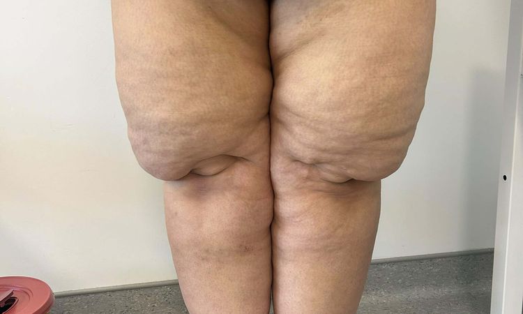 Lipedema is not just a weight problem, as thought: Expert Warns - Last Minute