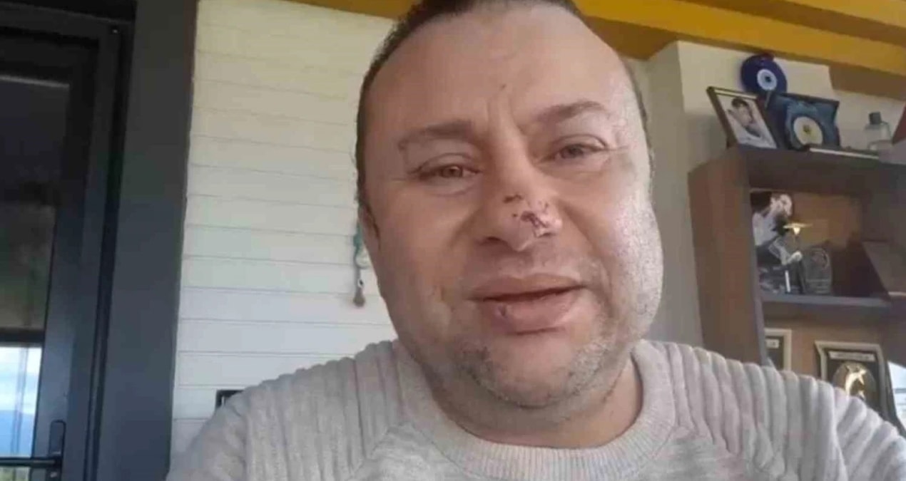 Gündemden Son Bilgiler: Pitbull saldırısında et yiyen bakteri bulaştı: İşte Onur Akay'ın son durumu - En Son H