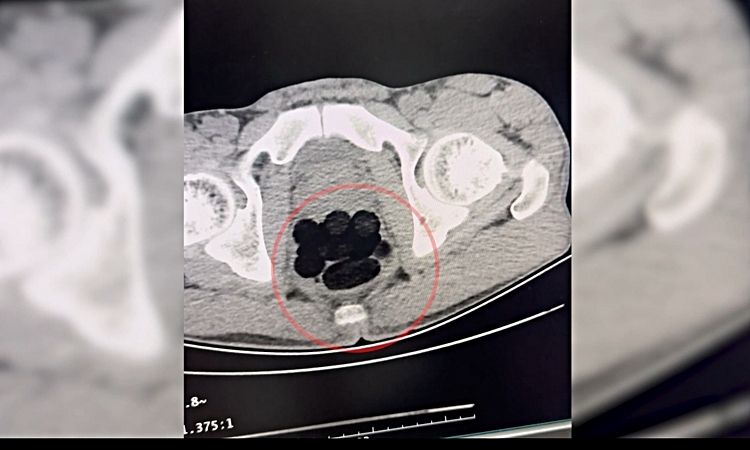Son Gelişme: Batman'da yabancı uyruklu şüphelinin midesinden 253,22 gram eroin çıktı, hakkında tutuklama karar