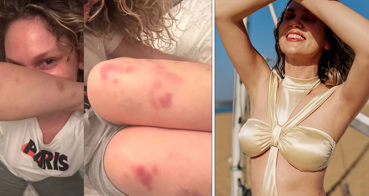 Kritik Açıklama: Vücudunun her yeri morardı: Farah Zeynep Abdullah’ın son paylaşımı endişelendirdi! - Son Daki