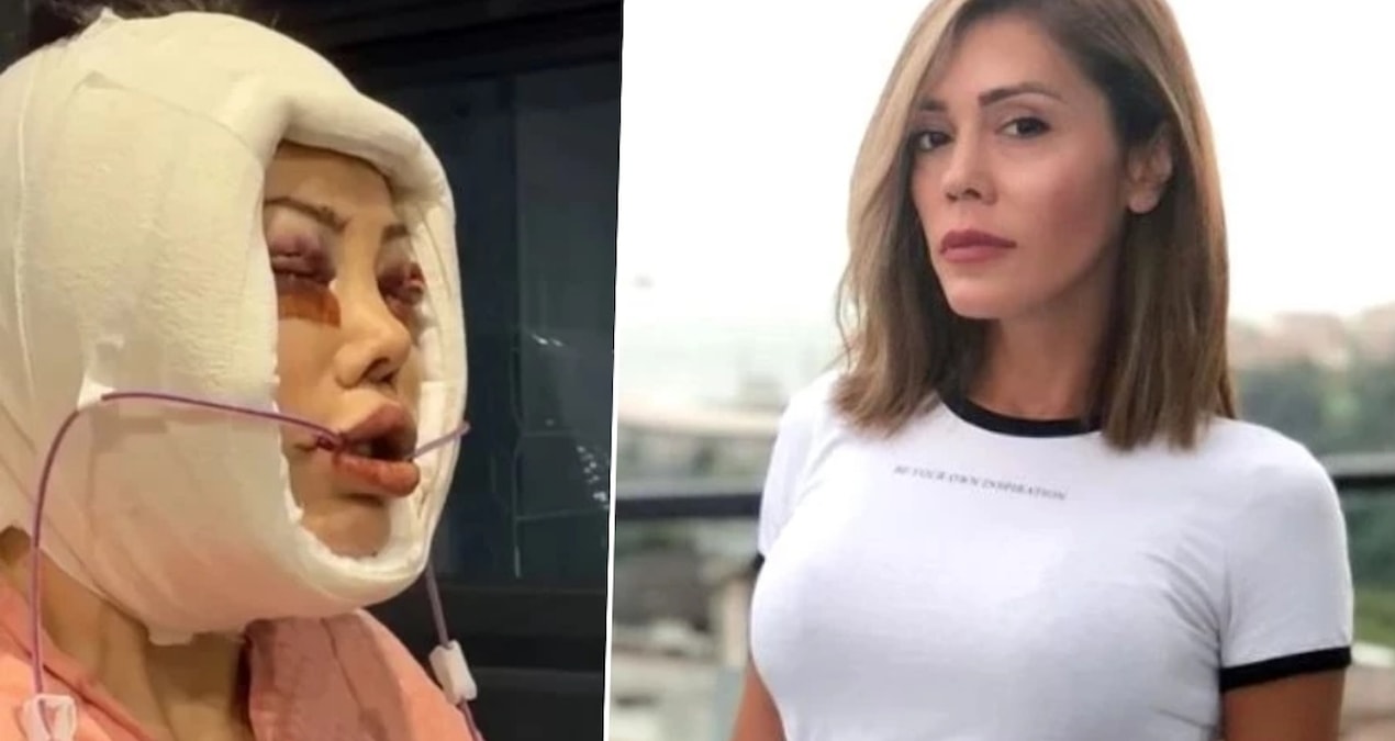 Ayrıntılar Netleşti: Yaptırdığı yüz nakliyle konuşulan Didem Ceran hastalığını ilk kez tüm detaylarıyla paylaş